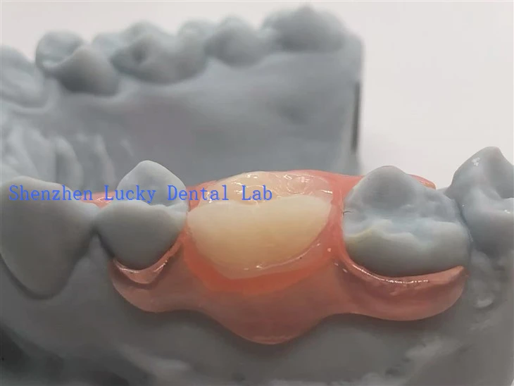 Stampa 3D Dental Dental Parzjali Dentatura Bil-Klasp Valplast