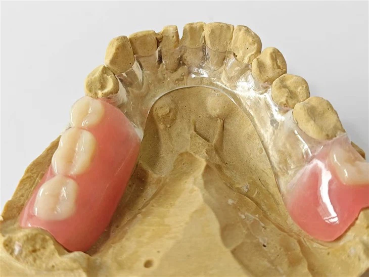 Frameowrk tal-metall ċar b'dentatura akrilika magħmula fiċ-Ċina