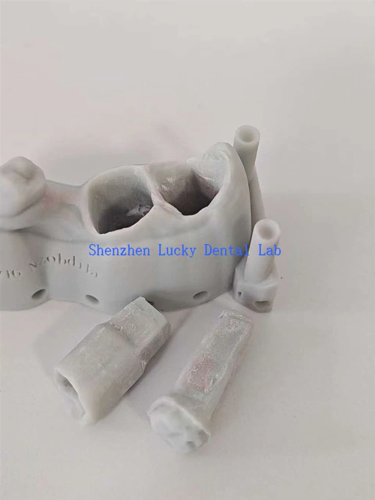 Die dentali li jista 'jinqala'